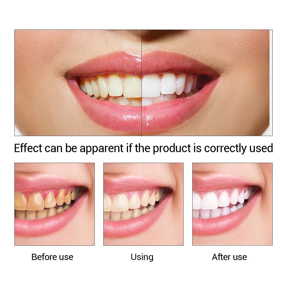 FTEENPLY-esencia para blanquea - Teeth Whitening/Bleaching reseña y precio