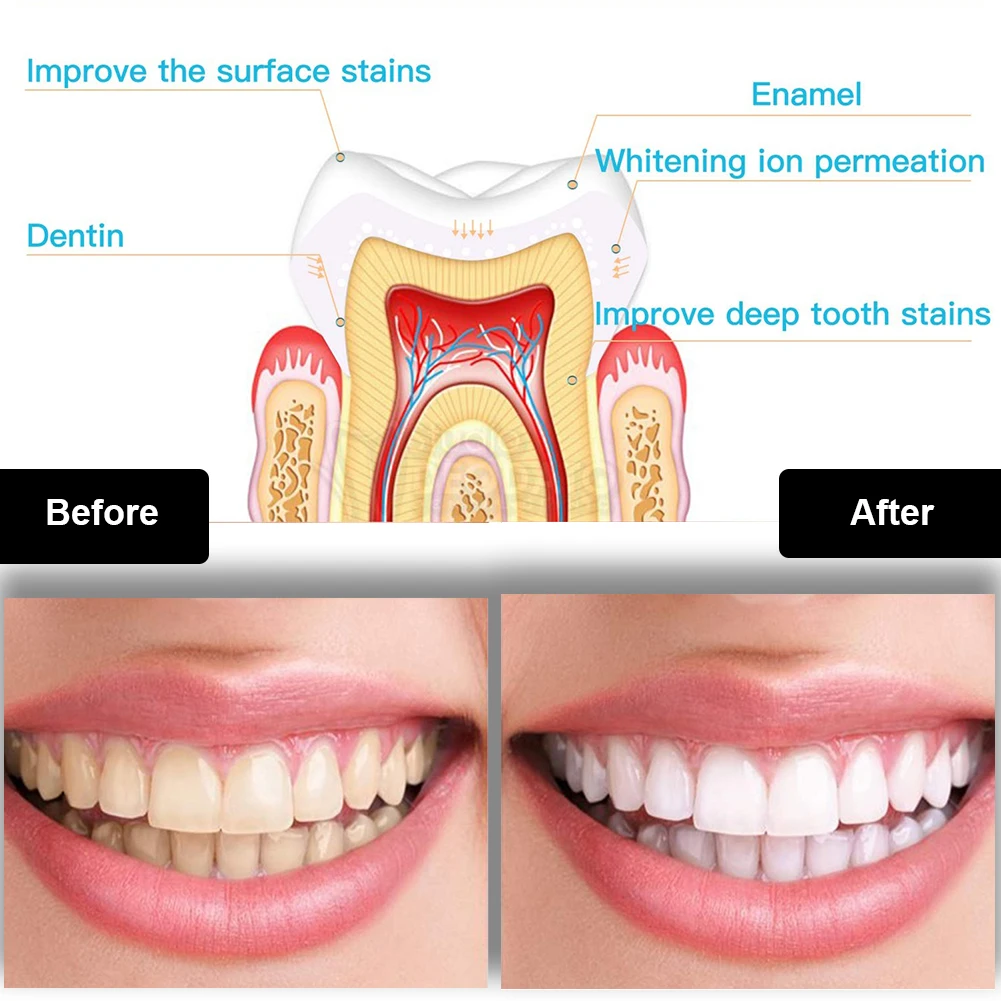 Kit de blanqueamiento Dental M - Teeth Whitening Vape reseña y precio